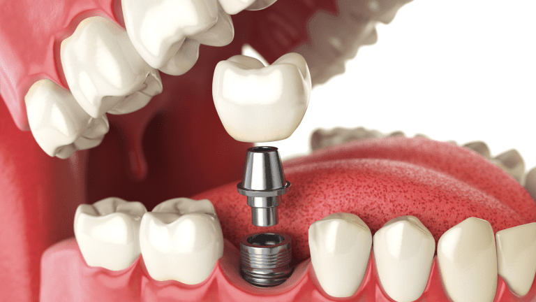 The Benefits of Implants and Advanced Implant Surgery for a Perfect Smile