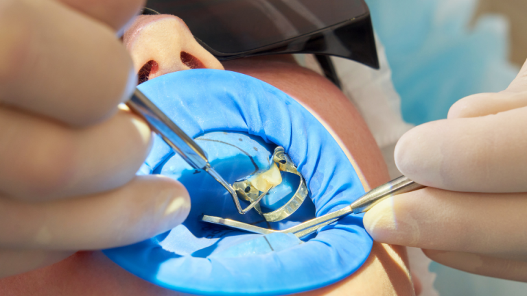 How Affordable Are Dental Implants in Turkey?